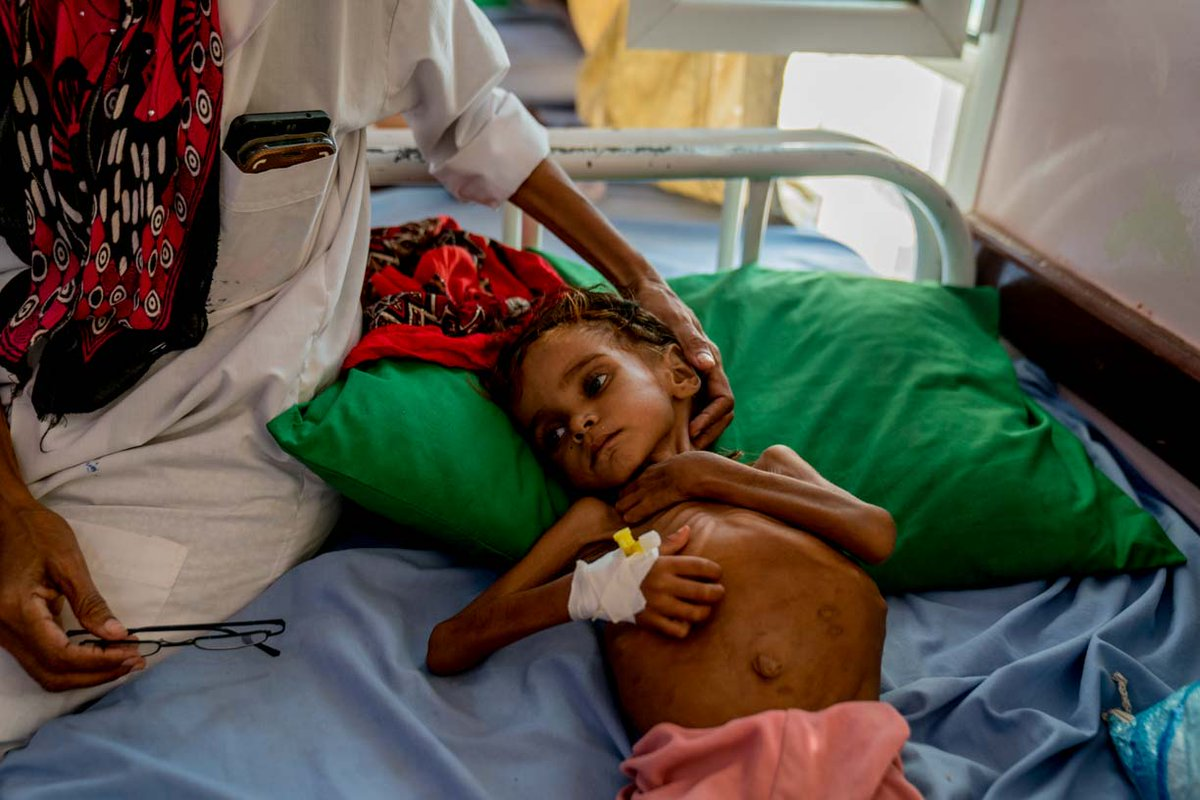Deklica, katere fotografija je pretresla ves svet, umrla zaradi podhranjenosti